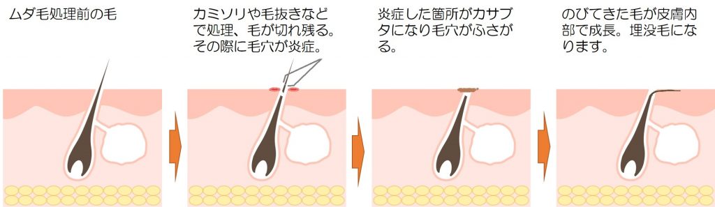 脇の埋没毛を治し方 脱毛 おすすめ