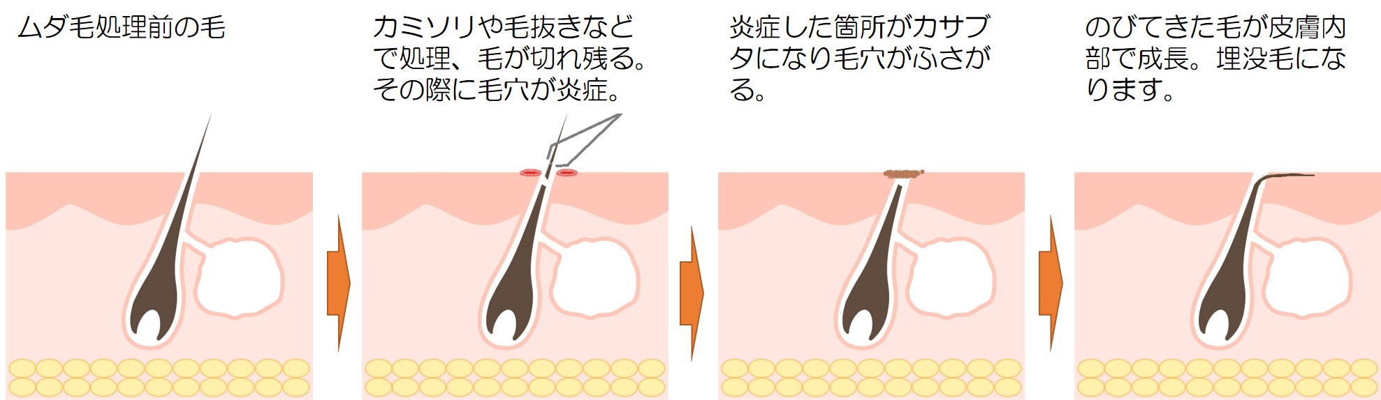 埋没毛 治し方 脱毛 おすすめ